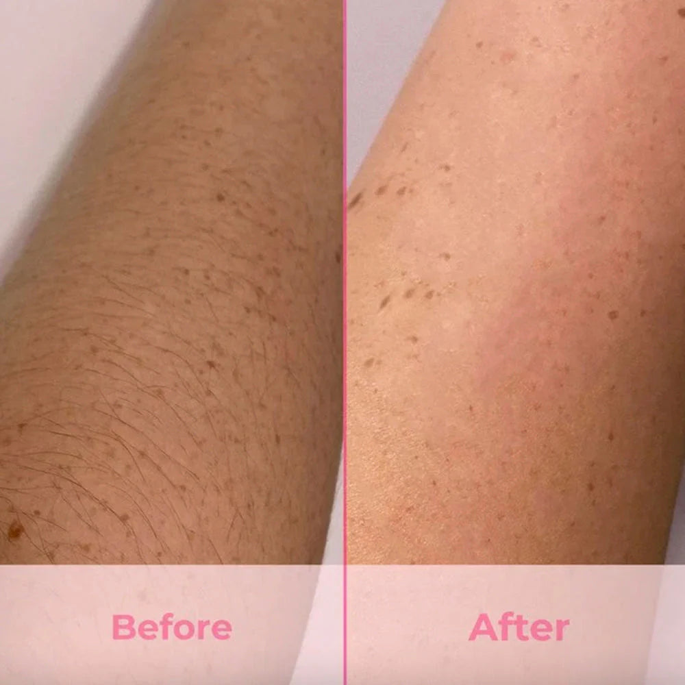 IPL Hair Removal