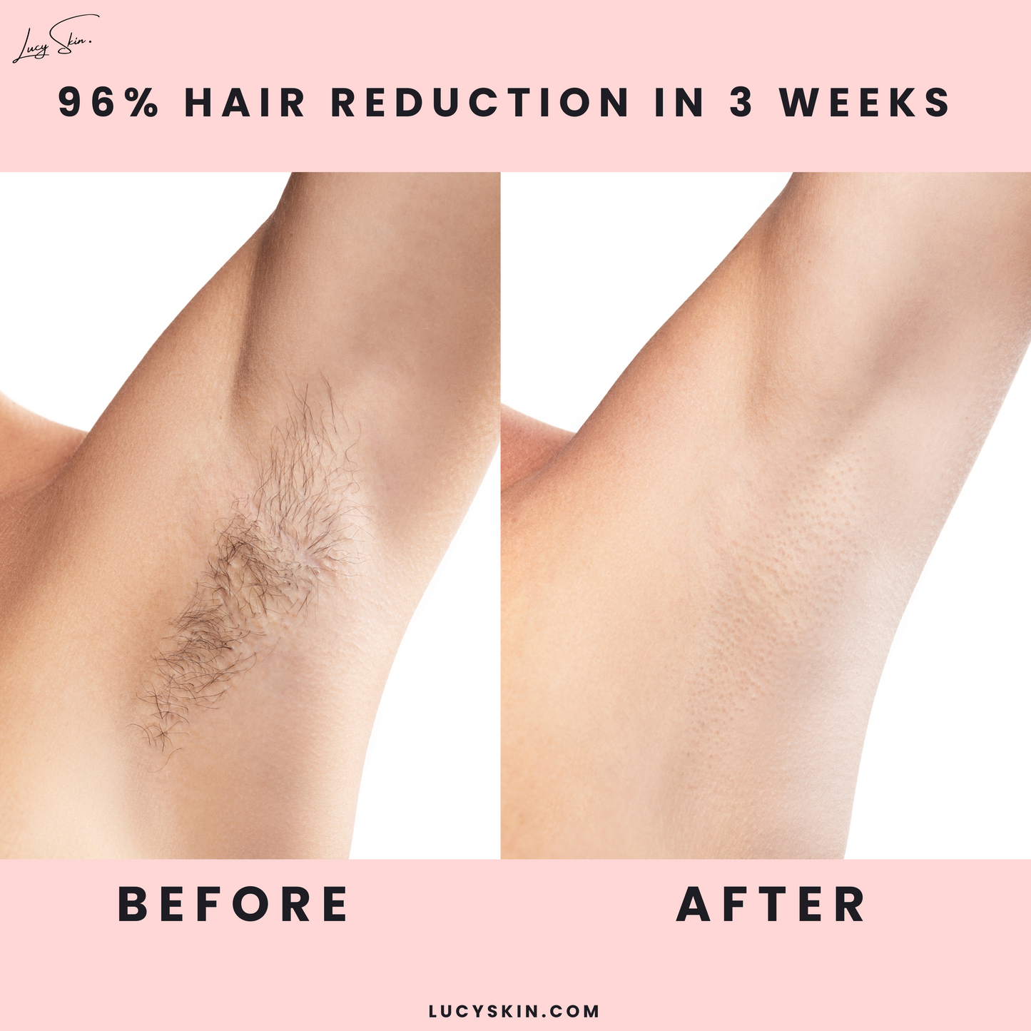 IPL Hair Removal